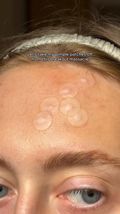 ✨ Cuide da sua pele com praticidade! Os Adesivos Hidrocolóides para Acne ajudam a cobrir espinhas, manchas e erupções #CuidadosComAPele #acne
